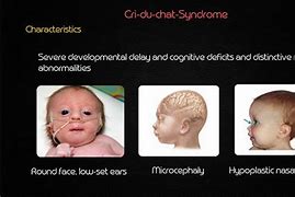 Image result for CRI Du Chat Syndrome Symptoms