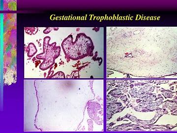 Image result for Types of Treatment for Gestational Trophoblastic Disease