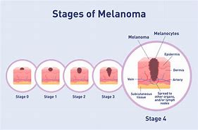 Image result for Melanoma Stage 4 Advanced