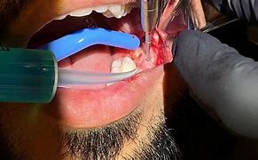 Image result for Wisdom Tooth Extraction Surgery