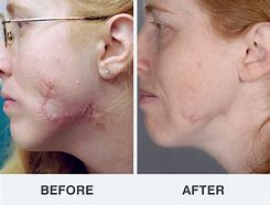 Image result for laser scars remove