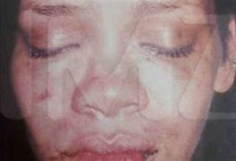 Image result for Rihanna Injuries