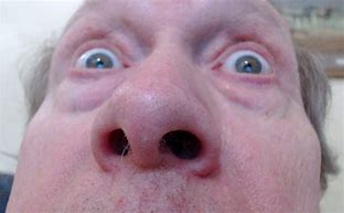 Image result for Nose Blemish