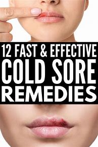 Image result for Natural Remedies for Cold Sores