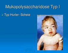 Image result for Kiefer Syndrome