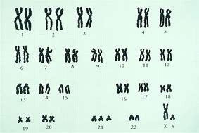 Image result for Trisomy Defects