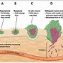 Image result for Stages of Cancer in the Human Body