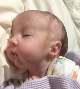 Image result for Babies Born with Trisomy 18