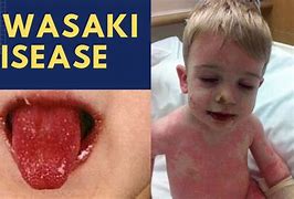 Image result for Kawasaki Disease Strawberry Tongue