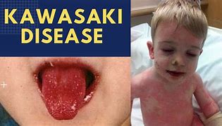 Image result for Kawasaki Disease Symptoms Neumonic