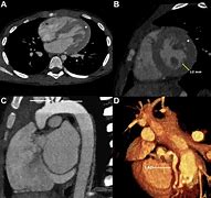 Image result for Williams Syndrome Heart