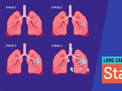 Image result for Stages of Lung Cancer 1-4