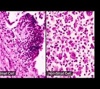 Image result for Small Oat Cell Lung Cancer