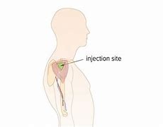Image result for Deltoid Intramuscular Injection