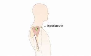Image result for Intramuscular Injection Anatomy
