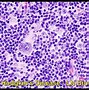 Image result for Lymphoma Tumor Pictures