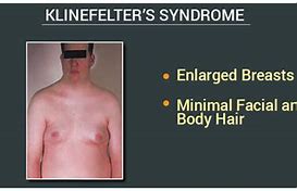 Image result for Klinefelter Syndrome Diagram