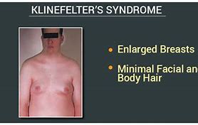 Image result for SVS Normal Karyotype Klinefelter Syndrome