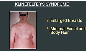 Image result for Men with Klinefelter's Syndrome