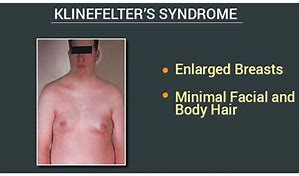 Image result for Klinefelter Syndrome Brown Spots
