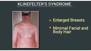 Image result for Klinefelter Syndrome Characteristics