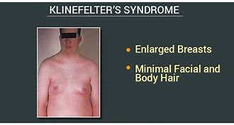 Image result for Klinefelter Syndrome Face