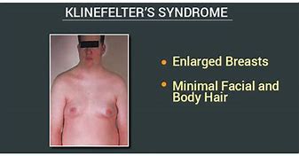 Image result for Klinefelter Syndrome Body Part Affected
