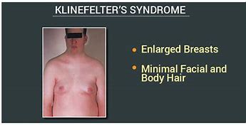 Image result for Symptoms of Klinefelter's Syndrome