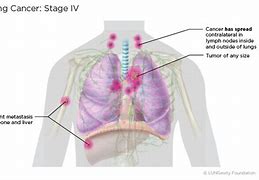 Image result for Stage 4 Metastatic Lung Cancer