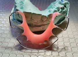 Image result for Removable Orthodontic Appliance