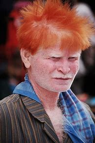 Image result for Albino Male
