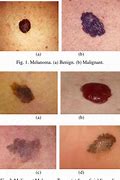 Image result for Stage 4 Melanoma Skin Cancer