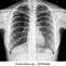 Image result for Normal Chest X-Ray