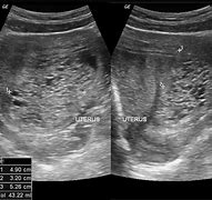 Image result for Hydatidiform Mole Ultrasound