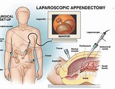 Image result for Lap Appy Complications