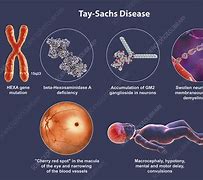 Image result for Tay-Sachs