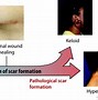 Image result for Types of Scar Tissue