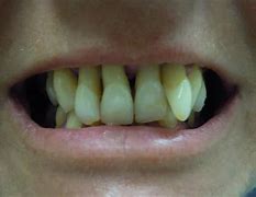 Image result for Extraction Dent