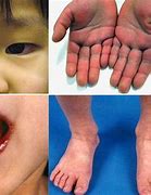 Image result for Kawasaki Disease Child