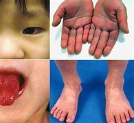 Image result for Kawasaki Disease Baby