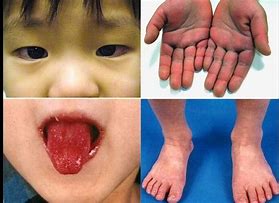 Image result for Kawasaki Disease Rash