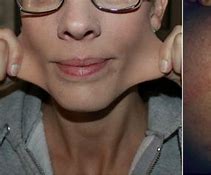 Image result for Ehlers-Danlos Syndrome Facial Features