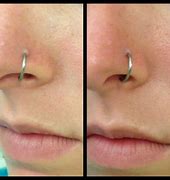 Image result for Infected Nose Piercing