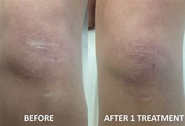 Image result for Scar Removal Before and After