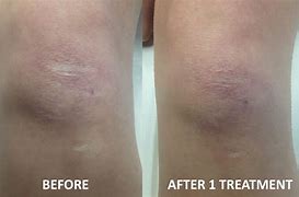 Image result for Scar Removal Before and After