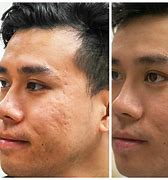Image result for Acne Scar Removal Surgery