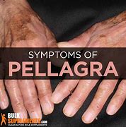 Image result for Pellagra