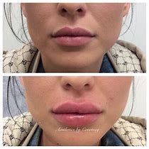 Image result for Good Lip Fillers