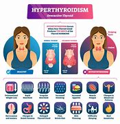 Image result for Hyperthyroidism