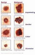 Image result for Symptoms of Stage 4 Melanoma